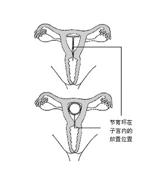遂宁上环最好的医院
