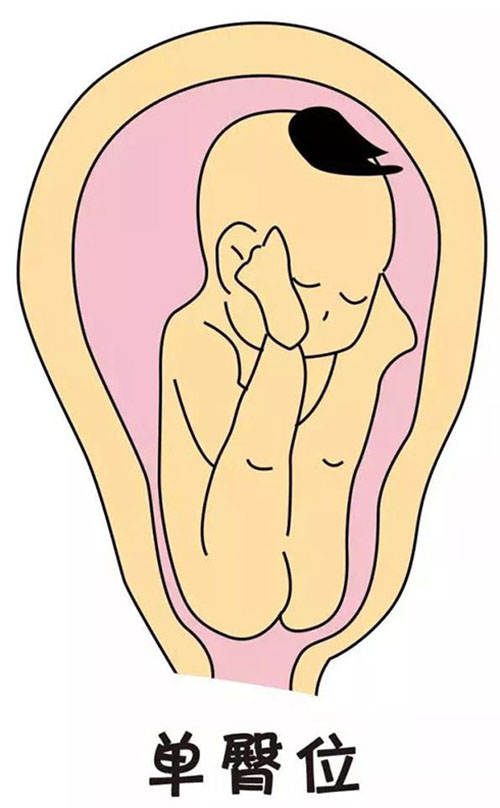 你想顺产吗?宝宝在子宫里有这些姿势吗?